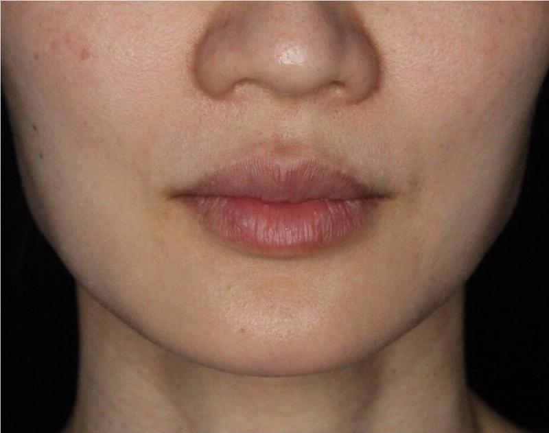 Dermal Fillers Before & After Gallery - Patient 133257038 - Image 3