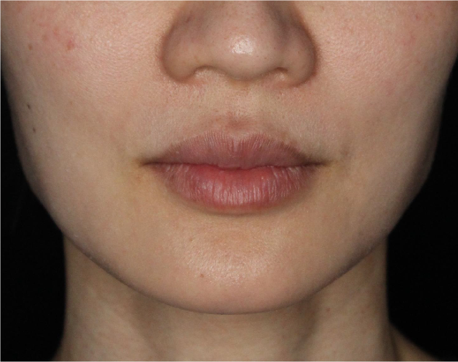 Dermal Fillers Before & After Gallery - Patient 133257038 - Image 3