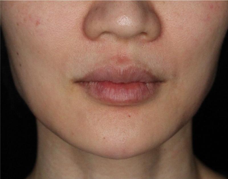 Dermal Fillers Before & After Gallery - Patient 133257038 - Image 4