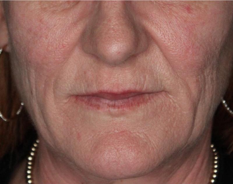 Dermal Fillers Before & After Gallery - Patient 133257040 - Image 5