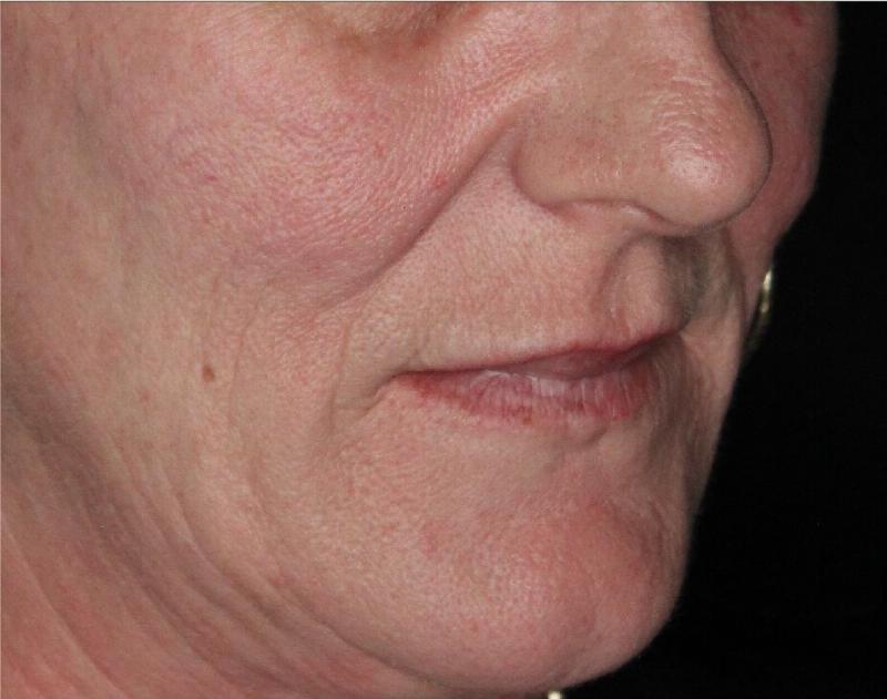 Dermal Fillers Before & After Gallery - Patient 133257040 - Image 3