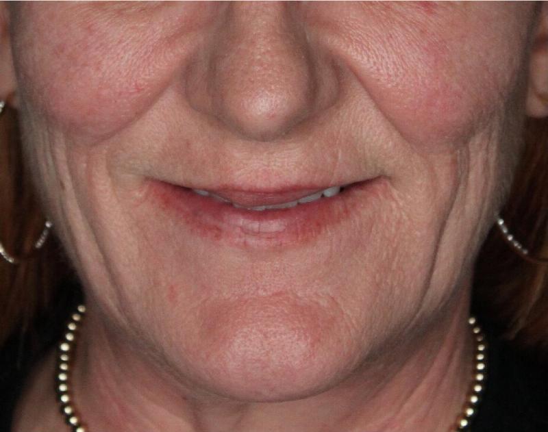 Dermal Fillers Before & After Gallery - Patient 133257040 - Image 1