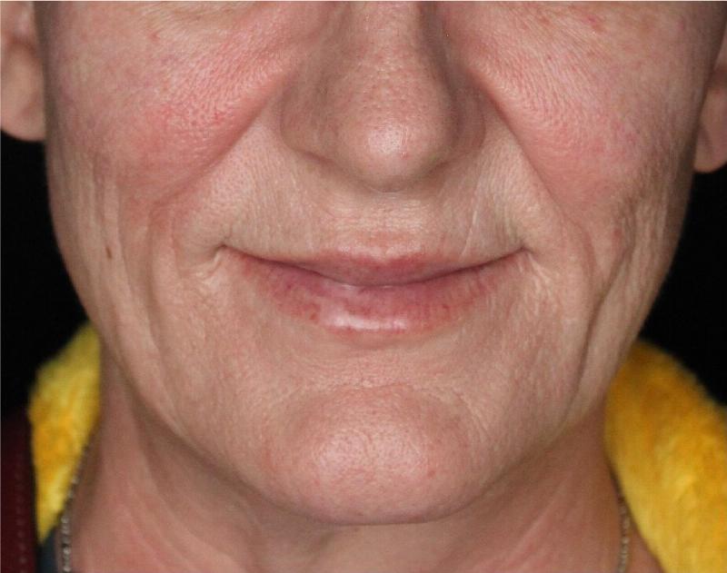 Dermal Fillers Before & After Gallery - Patient 133257040 - Image 2