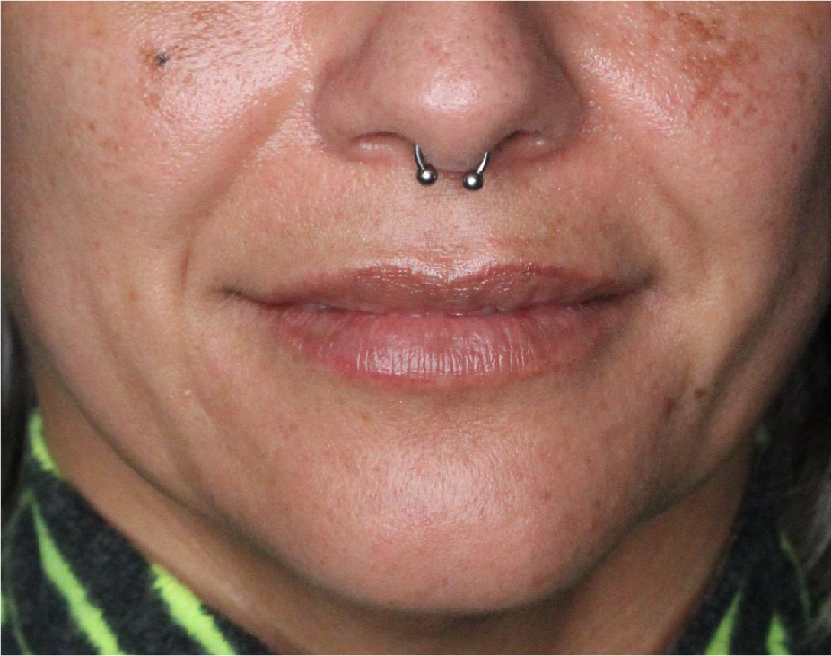 Dermal Fillers Before & After Gallery - Patient 133257041 - Image 3