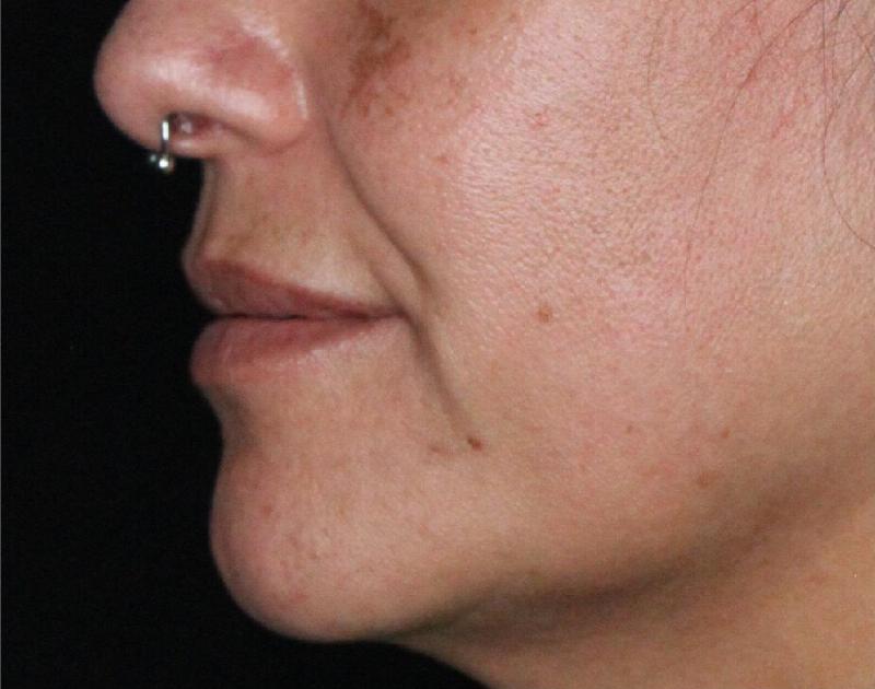 Dermal Fillers Before & After Gallery - Patient 133257041 - Image 5