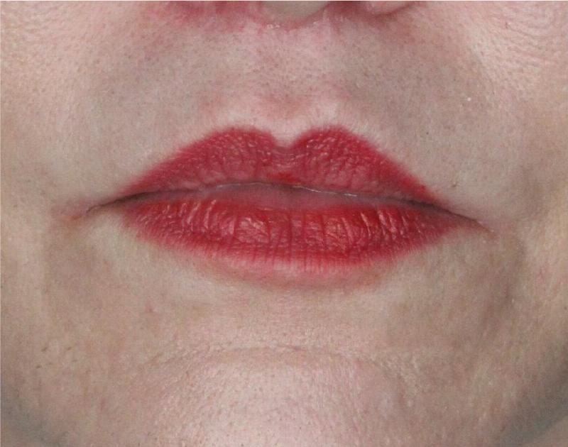 Lip Lift Before & After Gallery - Patient 89312967 - Image 2