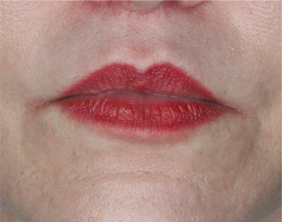 Lip Lift Before & After Gallery - Patient 89312967 - Image 2