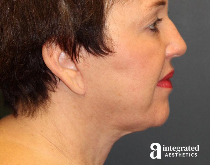 Facelift & Neck Lift Before & After Gallery - Patient 89319062 - Image 2