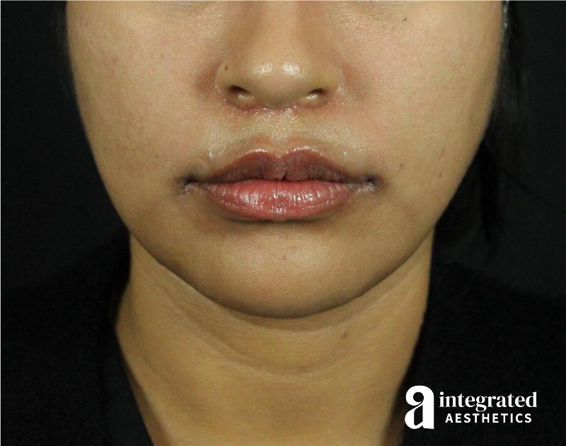 Lip Lift Before & After Gallery - Patient 89319068 - Image 4