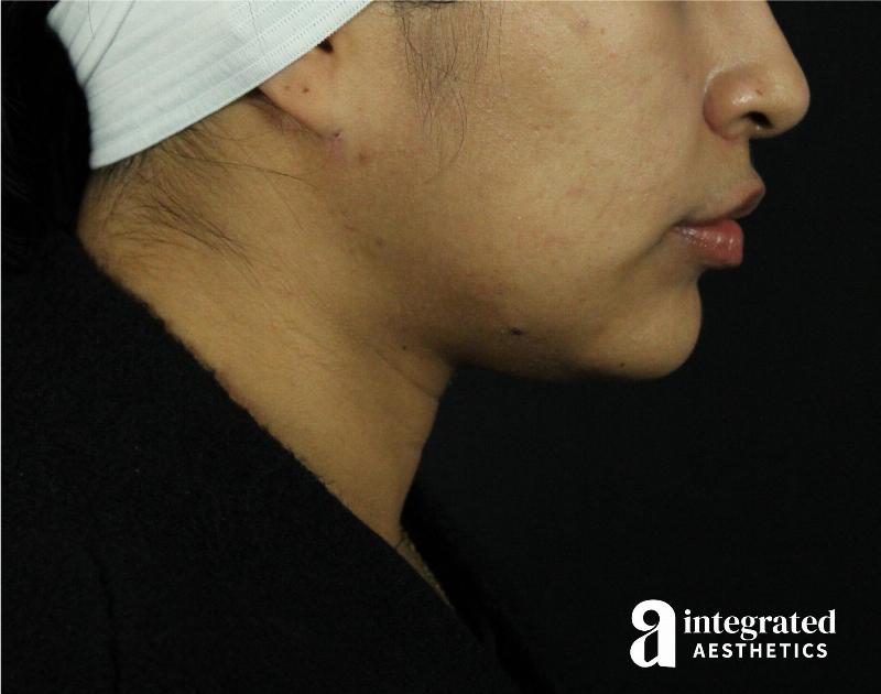 Lip Lift Before & After Gallery - Patient 89319068 - Image 6