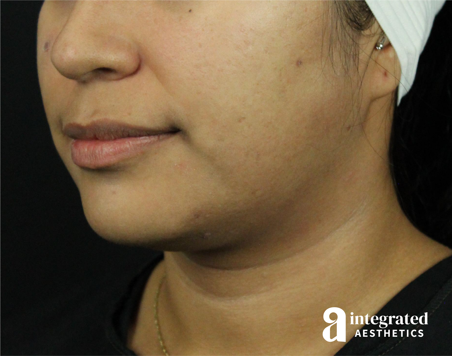 Lip Lift Before & After Gallery - Patient 89319068 - Image 7