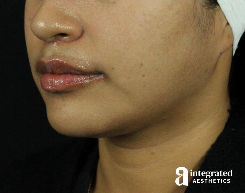 Lip Lift Before & After Gallery - Patient 89319068 - Image 8