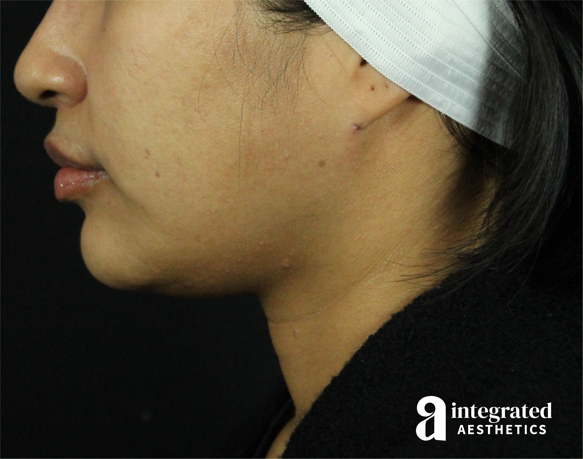 Lip Lift Before & After Gallery - Patient 89319068 - Image 10