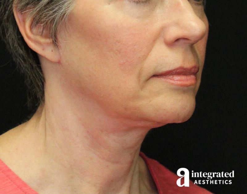 Facelift & Neck Lift Before & After Gallery - Patient 89325157 - Image 6