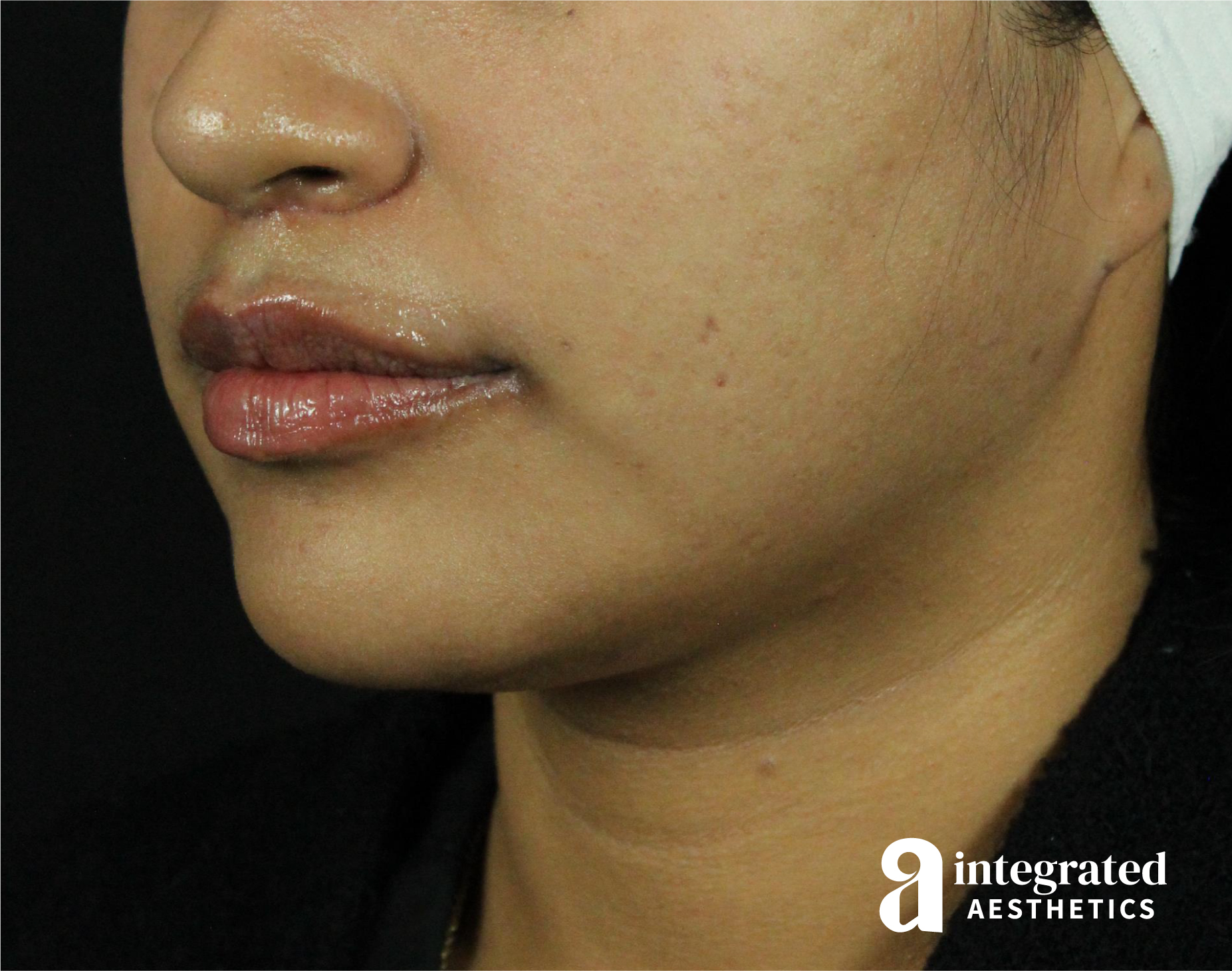 FaceTite & AccuTite Before & After Gallery - Patient 89337380 - Image 8