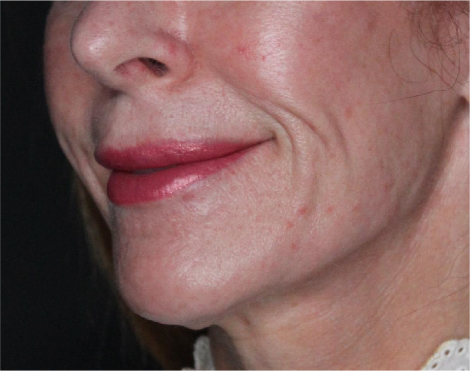 Sculptra Before & After Gallery - Patient 89337379 - Image 5