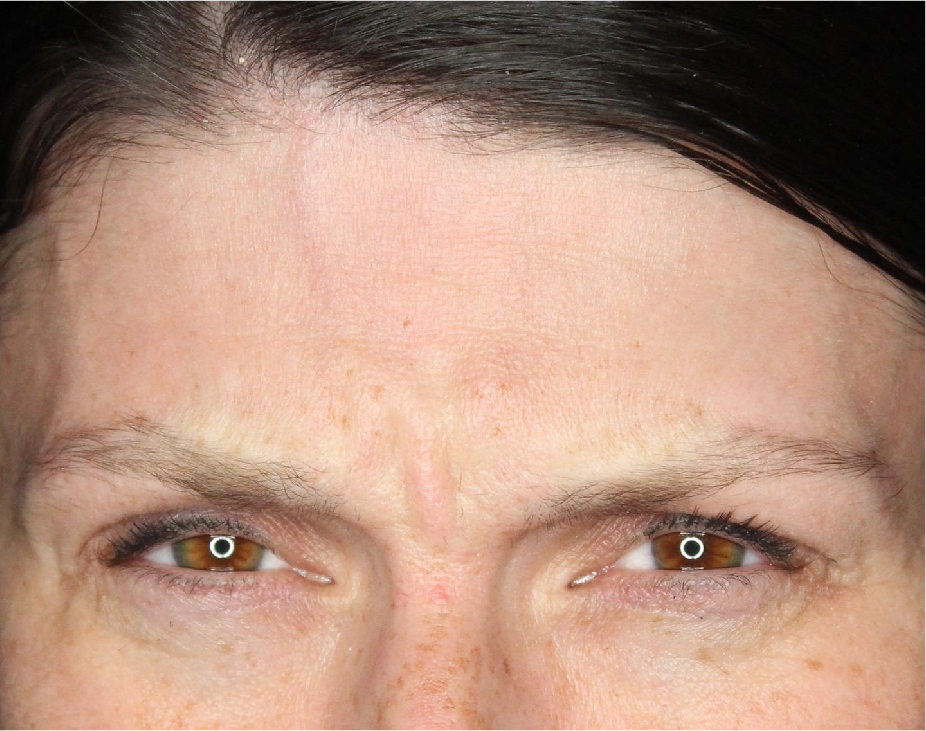 Wrinkle Relaxers Before & After Gallery - Patient 89343494 - Image 3