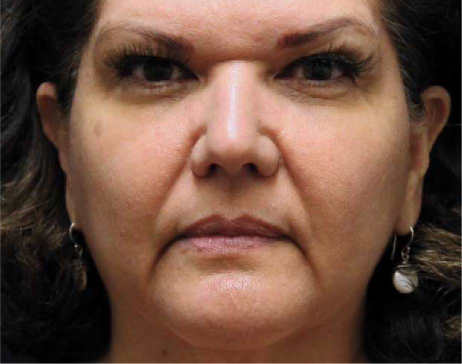 Wrinkle Relaxers Before & After Gallery - Patient 89349595 - Image 1