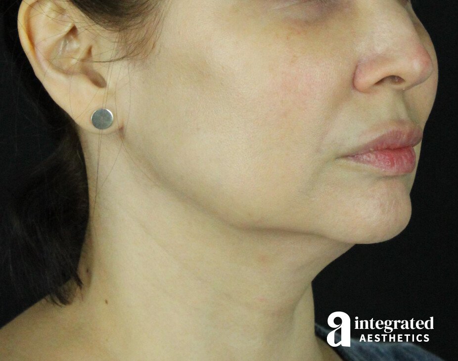 FaceTite & AccuTite Before & After Gallery - Patient 89349601 - Image 1