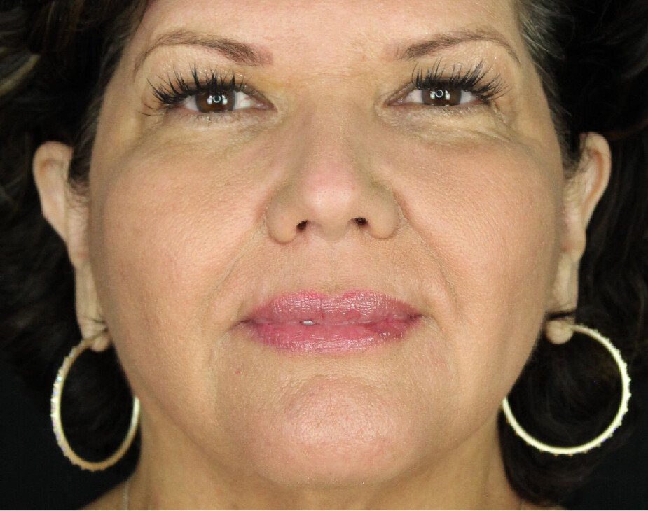 Suture Lift Before & After Gallery - Patient 89349602 - Image 2