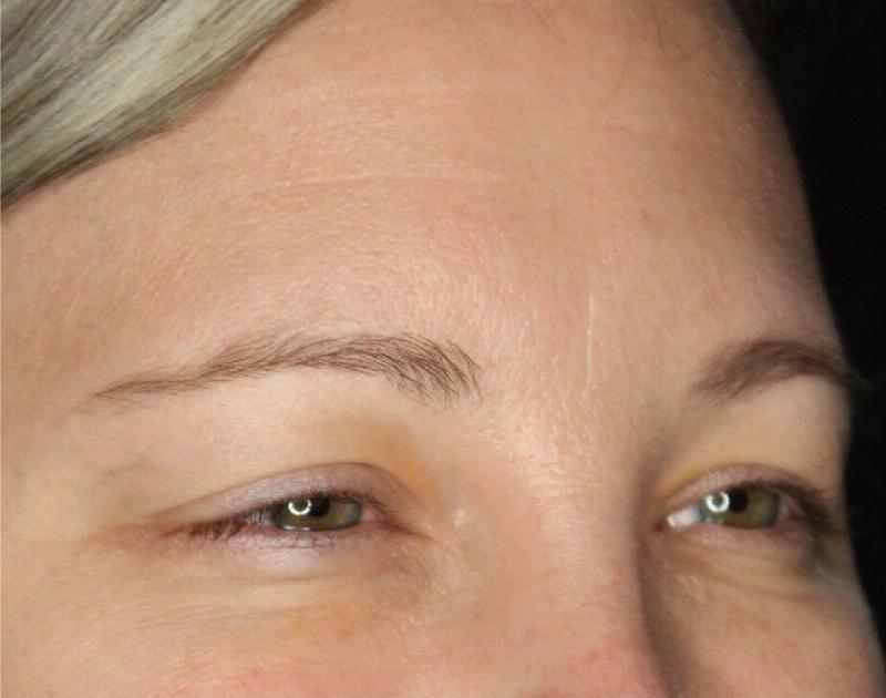 Wrinkle Relaxers Before & After Gallery - Patient 89349599 - Image 4