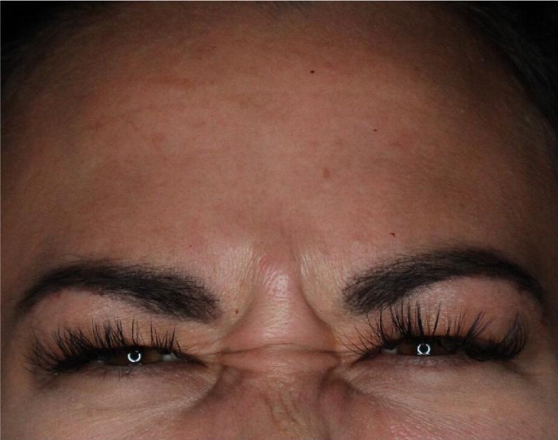 Wrinkle Relaxers Before & After Gallery - Patient 89349611 - Image 3