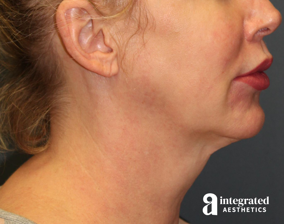 FaceTite & AccuTite Before & After Gallery - Patient 157150840 - Image 7