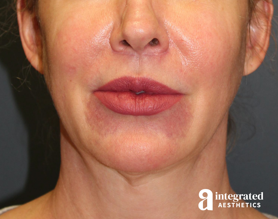 FaceTite & AccuTite Before & After Gallery - Patient 157150840 - Image 3