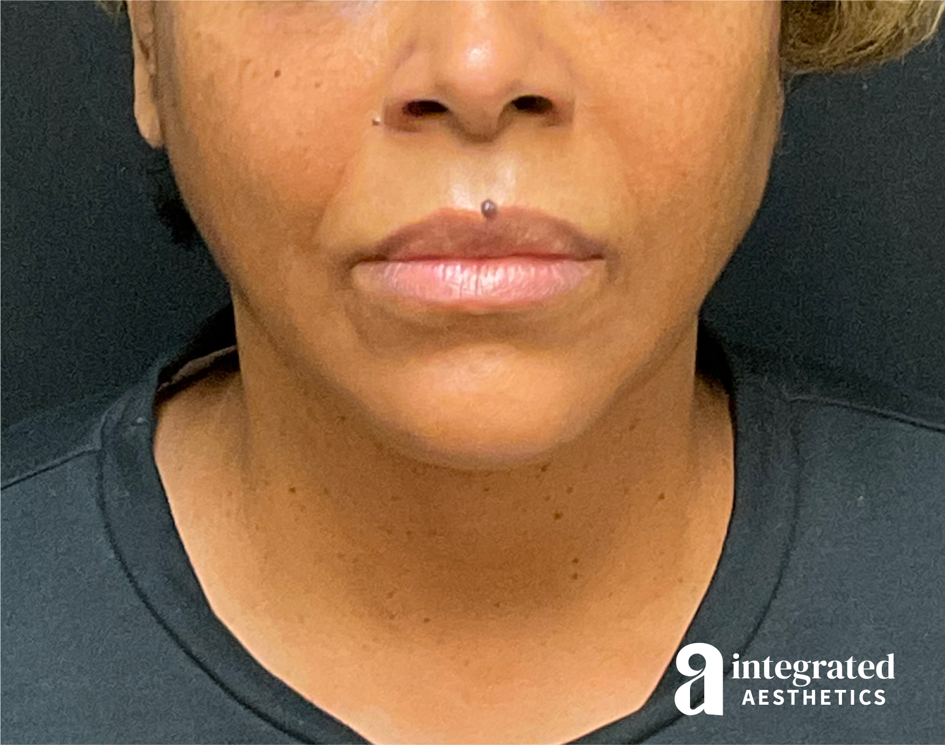 FaceTite & AccuTite Before & After Gallery - Patient 89349657 - Image 4