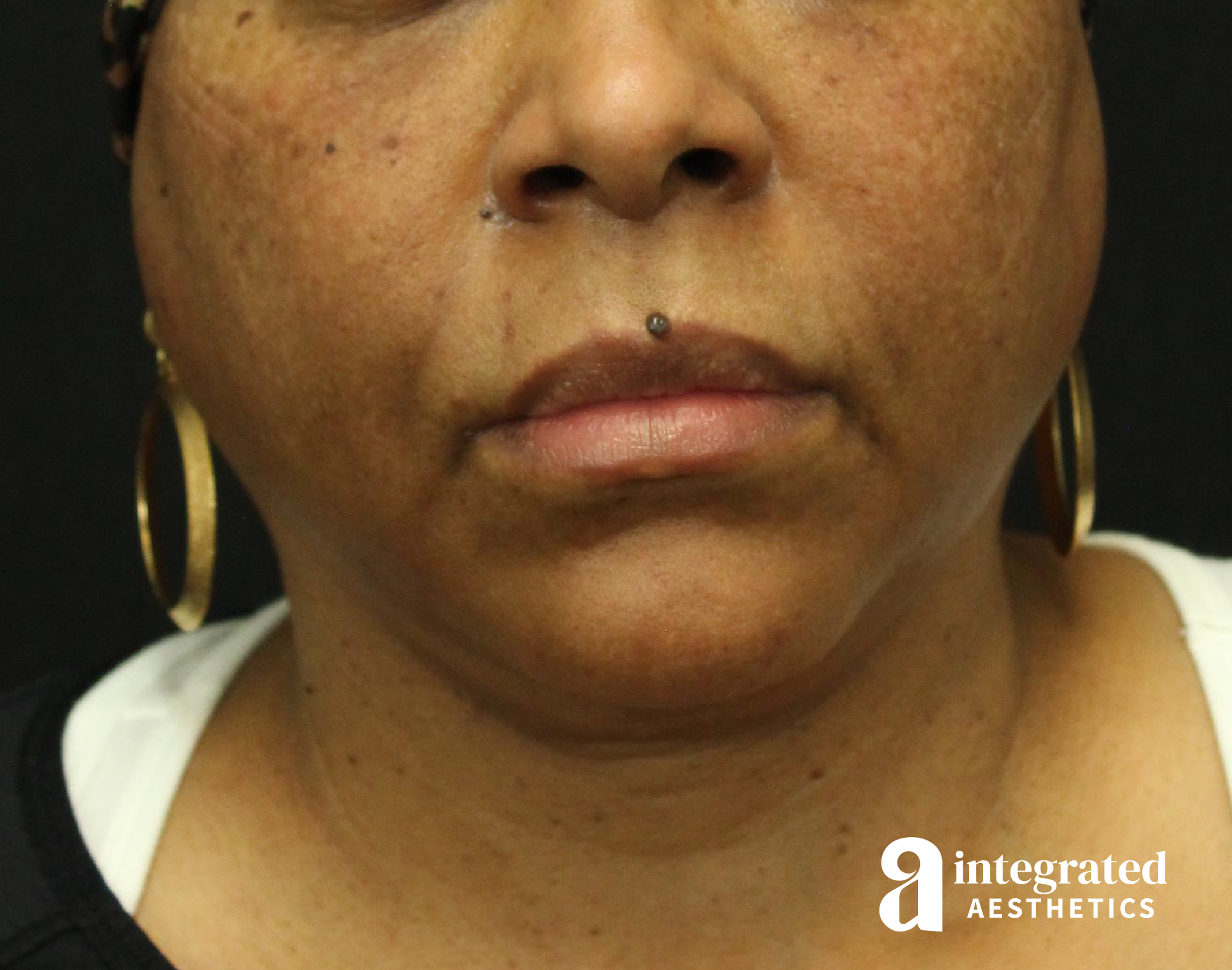 FaceTite & AccuTite Before & After Gallery - Patient 89349657 - Image 5