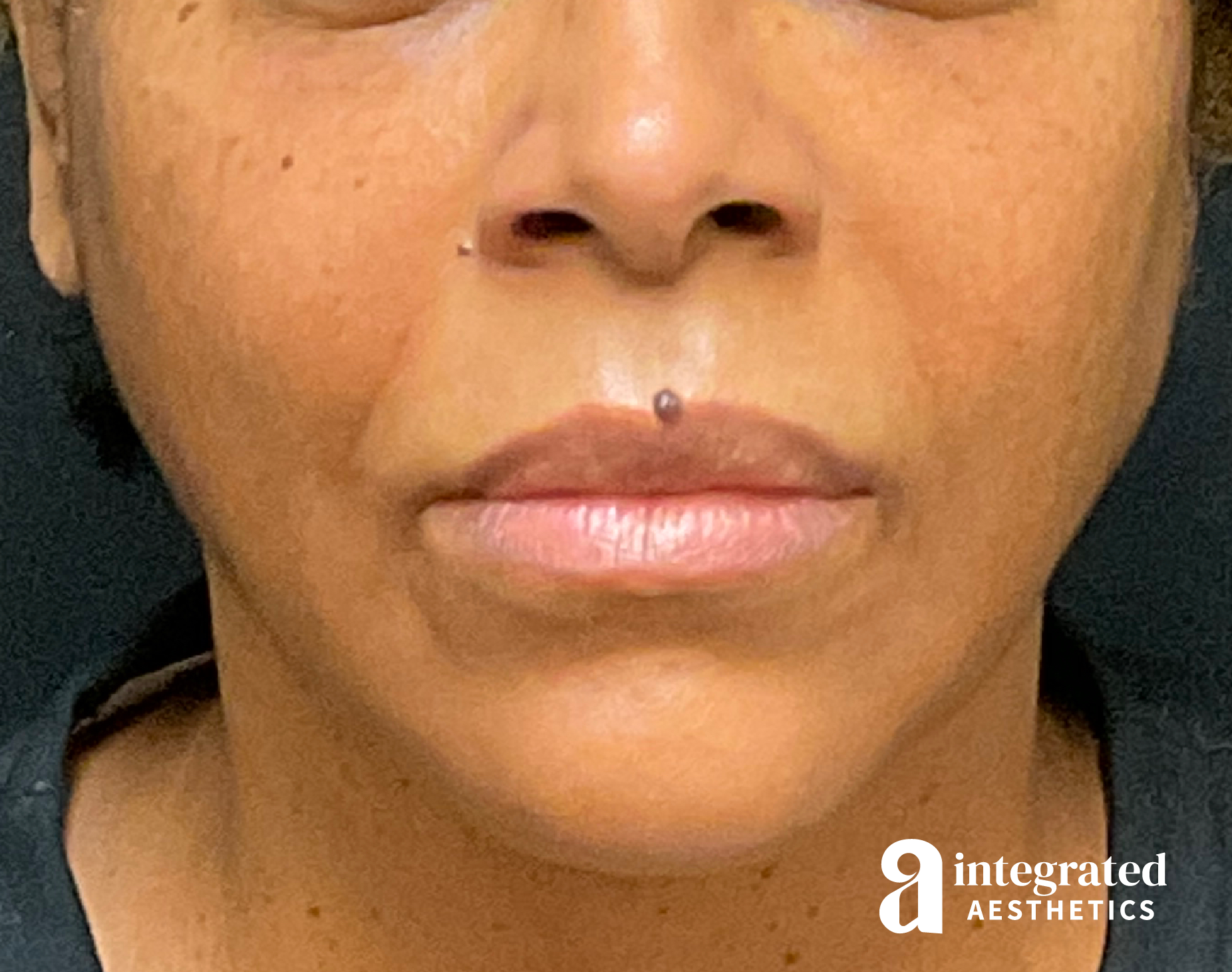 FaceTite & AccuTite Before & After Gallery - Patient 89349657 - Image 6