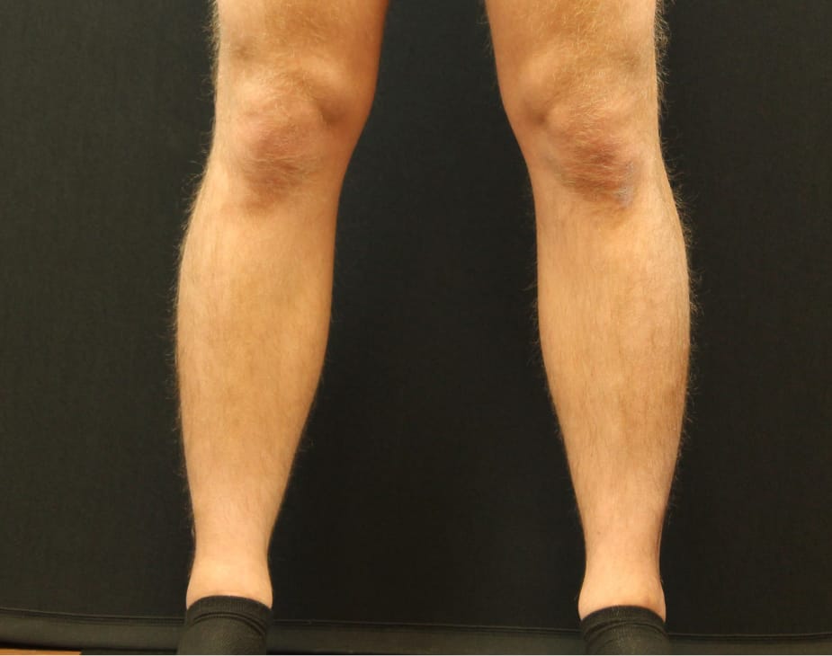 Calf Sculpting Before & After Gallery - Patient 90700495 - Image 1