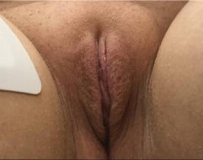 Labiaplasty Before & After Gallery - Patient 90700569 - Image 2