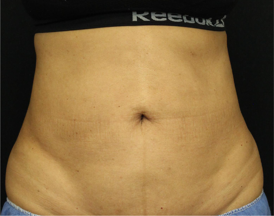 EmSculpt Before & After Gallery - Patient 90700571 - Image 6