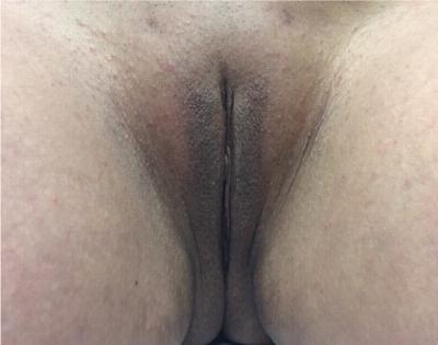 Labiaplasty Before & After Gallery - Patient 90700578 - Image 2