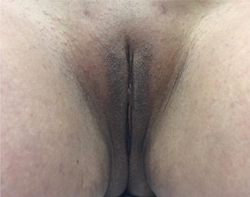 Labiaplasty Before & After Gallery - Patient 90700578 - Image 2