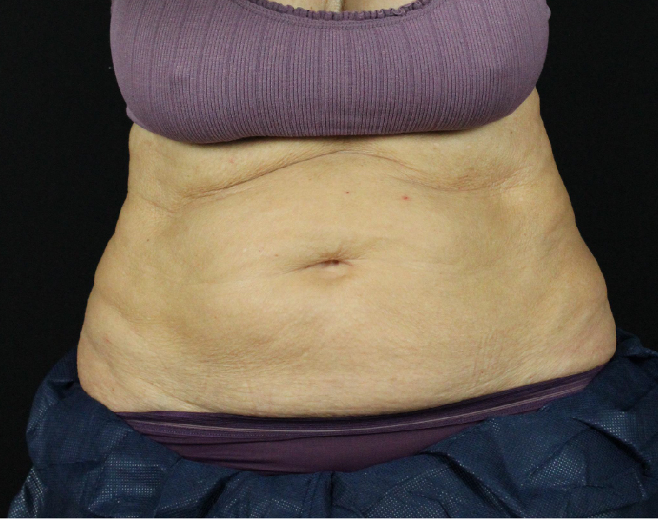 EmSculpt Before & After Gallery - Patient 90700583 - Image 1