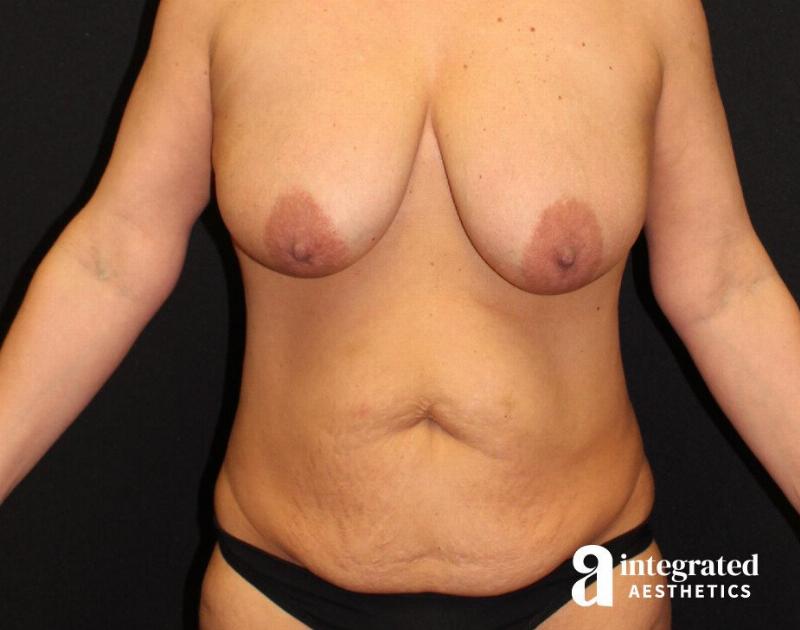 Tummy Tuck Before & After Gallery - Patient 90700665 - Image 5