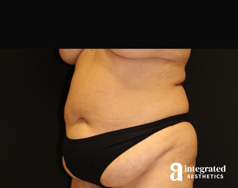 Tummy Tuck Before & After Gallery - Patient 90700692 - Image 1