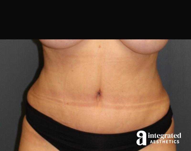 Tummy Tuck Before & After Gallery - Patient 90700692 - Image 4