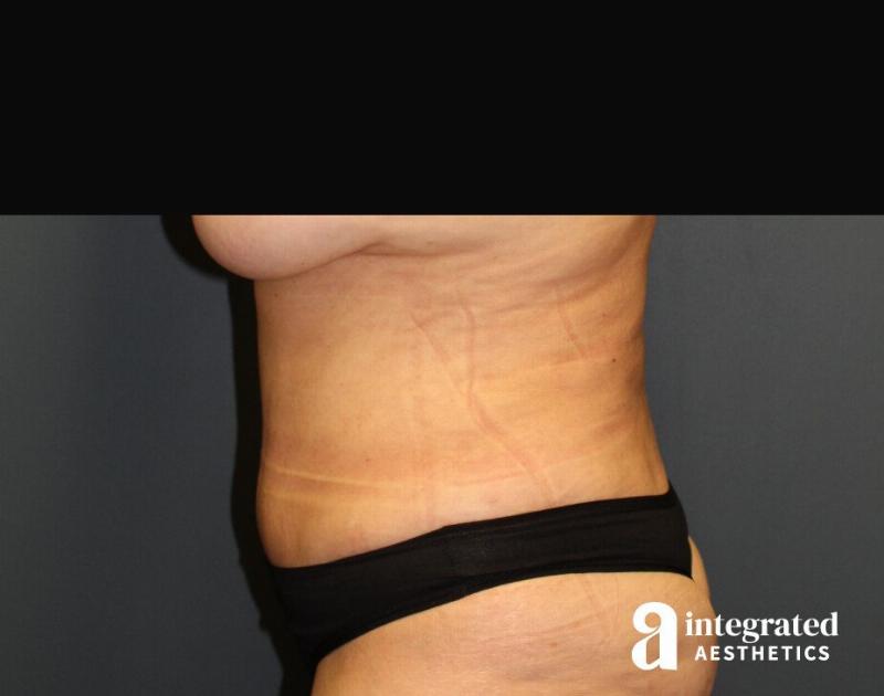 Tummy Tuck Before & After Gallery - Patient 90700692 - Image 6