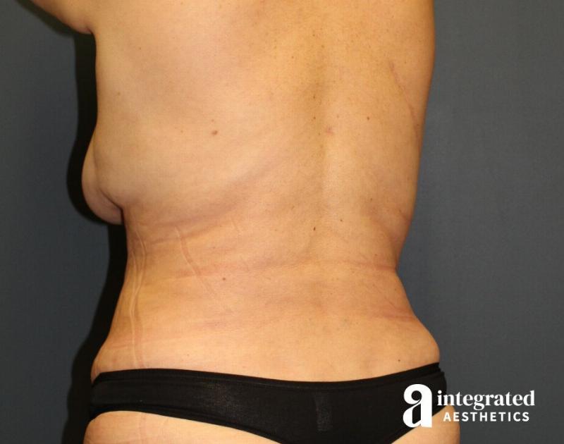 Tummy Tuck Before & After Gallery - Patient 90700692 - Image 8