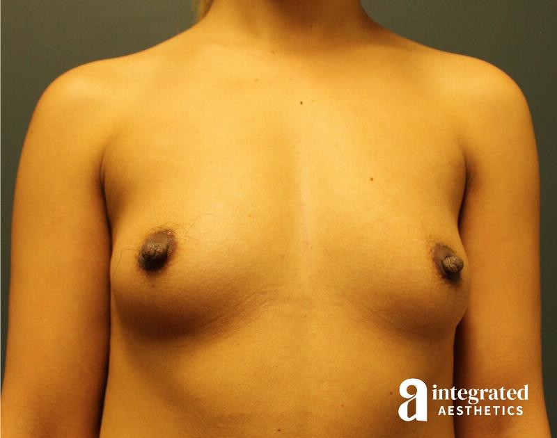 Breast Augmentation Before & After Gallery - Patient 90700739 - Image 1