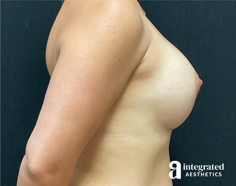 Breast Augmentation Before & After Gallery - Patient 90700795 - Image 6