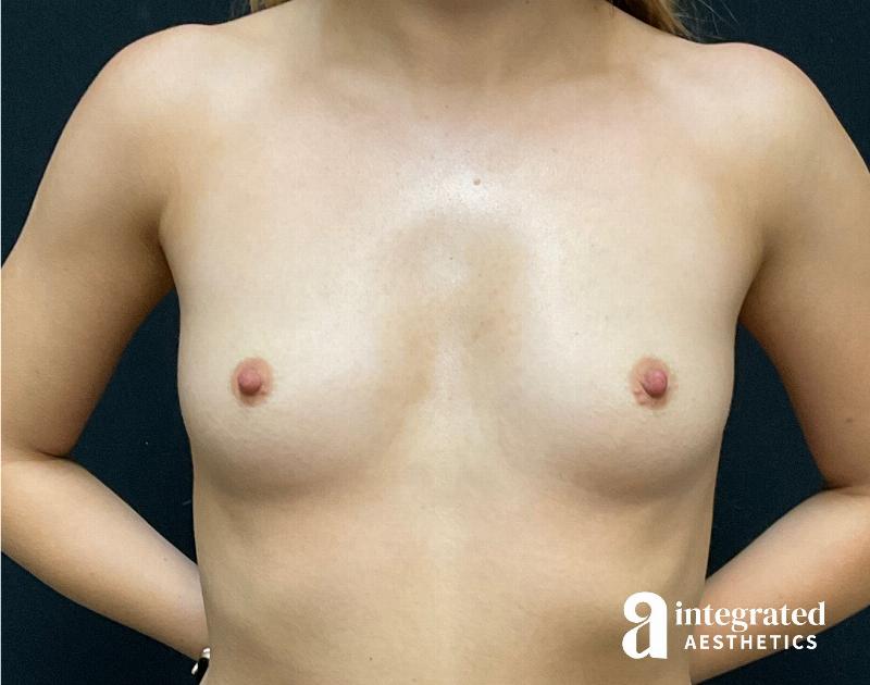 Breast Augmentation Before & After Gallery - Patient 133211535 - Image 1