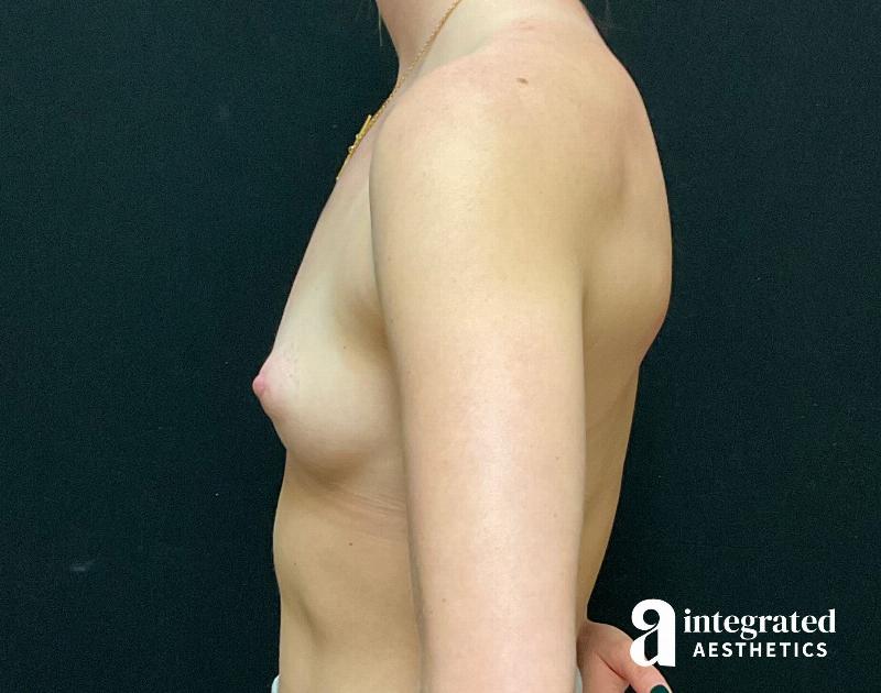 Breast Augmentation Before & After Gallery - Patient 90702319 - Image 9