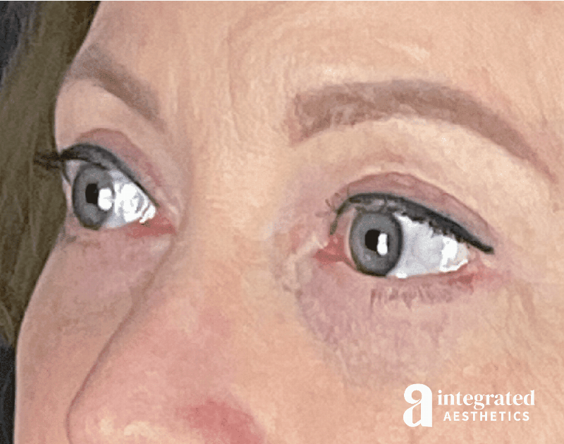 Blepharoplasty Before & After Gallery - Patient 133211156 - Image 4