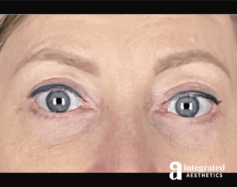 Blepharoplasty Before & After Gallery - Patient 133211156 - Image 2