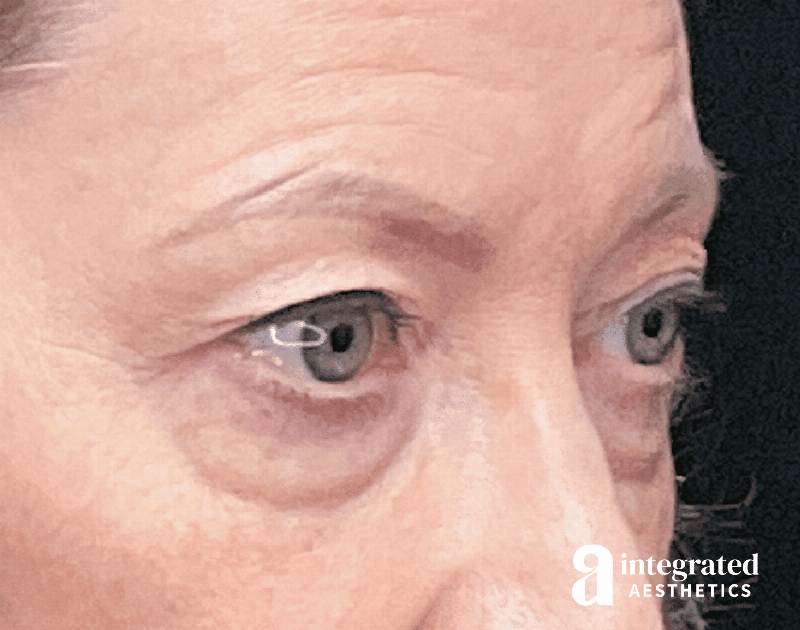 Blepharoplasty Before & After Gallery - Patient 133211156 - Image 5