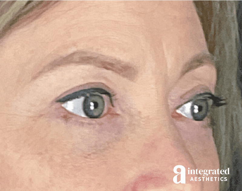 Blepharoplasty Before & After Gallery - Patient 133211156 - Image 6